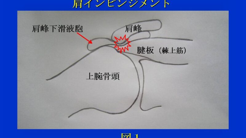 肩の痛み 
